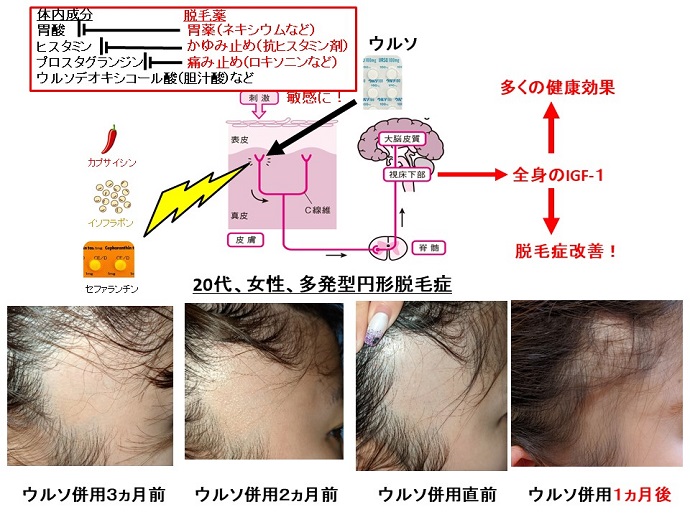 円形脱毛症　病院